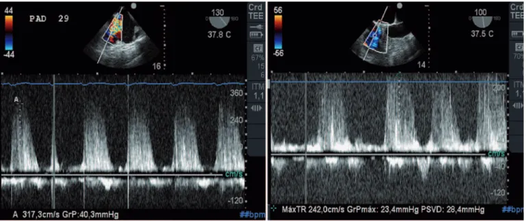 Figure 5 – PASP estimation (left) before CA at 69 mmHg and after nitric oxide with lower value.