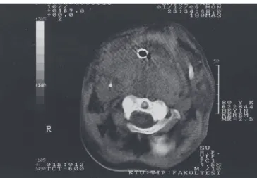 Table I – Analysis of the Indexed Articles Published since 1977  referred to “Retropharyngeal Hematoma due to Secondary Trauma” 