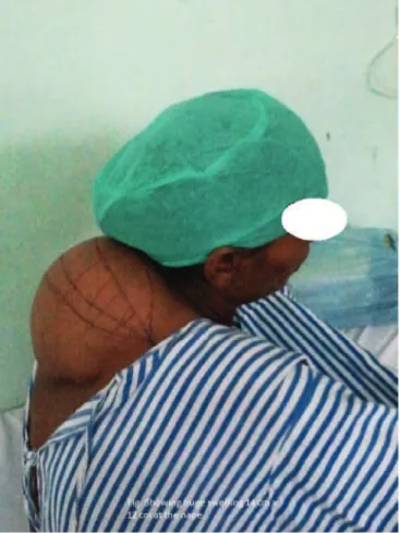 Figure 1  –  Swelling (lipoma) on the Posterior Aspect of Neck.