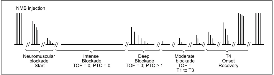 Table I – Comparison of Sensitivity, Specificity, Positive and  Negative Predictive Value of Tests with Double Burst Stimulation of  the Adductor Pollicis Muscle of the Ulnar Nerve, Tetanic stimulation  at 100 Hz and Acceleromyography to Detect Postoperati
