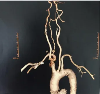 Figura 1- Angio-tomografia com acentuada estenose de carótida interna direita. Fonte: o autor