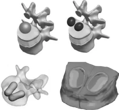 Figura 6.4 – Formas de modelar a cimentação óssea adaptado de (Li &amp; Lewis 2010; Villarraga Ph D et al