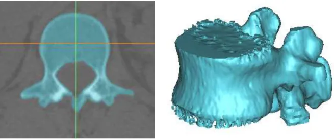 Figura 7.1  –  Modelo 3D da vértebra L1 gerado no Mimics. Tresholding aplicado a uma fatia da tomografia  computorizada (à esquerda) e nuvem de pontos (à direita).