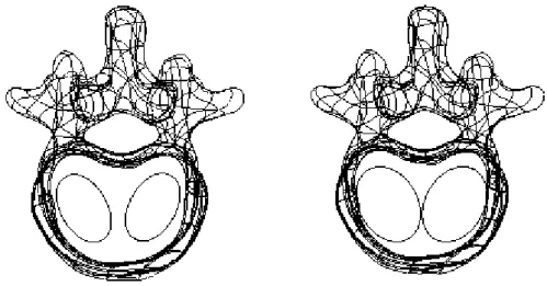 Figura 7.6 – Modelação da cimentação óssea bipedicular: dois esferóides prolatos com 10% do volume do  corpo vertebral à esquerda e com 20% à direita