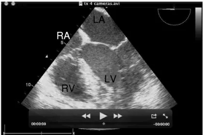 Figure 4 – Short Axis View of Aortic Valve and Inlet and Outlet  Pathways of Right Ventricle through the Mid Esophagus