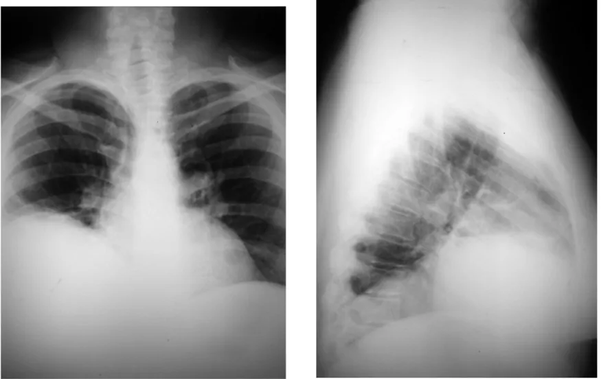 Figure 1 – Chest X-rays, Posteroanterior and Lateral Views, Showing Elevation of Right Hemidiaphragmatic Dome.