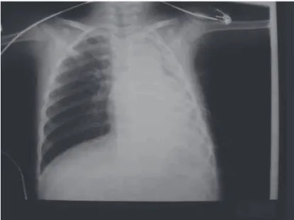 Figure 1 – X-Ray after Pleural Drainage in 5 th  Left Intercostal Space. 
