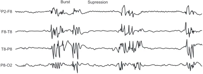 Figure 2 – Presence of Burst-Suppression.