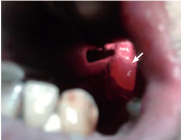 Figure 1 Vallecular cyst.