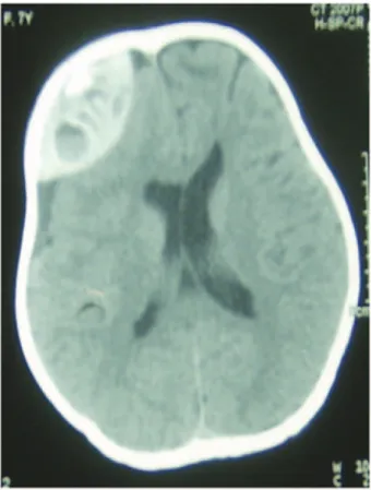 Figura 1 – Fotografía del niño con osteogénesis imperfecta  antes del monitoreo.