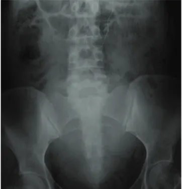 Figura 1  Radiografía abdominal postoperatoria. 