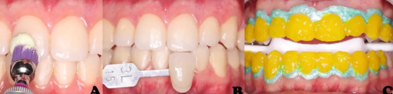 Figura 2 - em A: remoção do gel clareador apenas nos hemiarcos direitos; em B: aspecto após  remoção; em C: reaplicação do agente