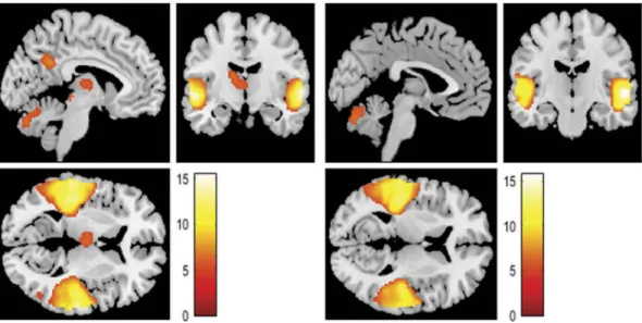 Table 3. Differences in brain activation between self and other conditions; Voxel Threshold: p ≤ .005; Cluster Size Threshold: