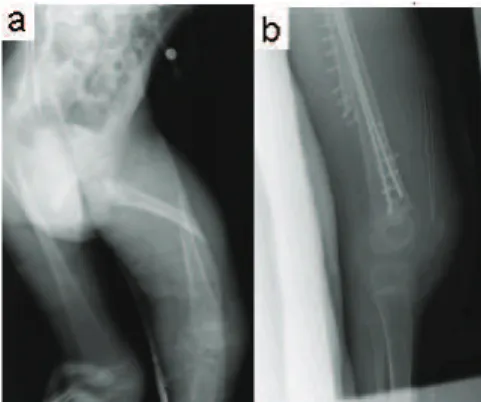 Figura 2  Visión del fémur derecho del paciente antes (a) y  después (b) de la operación.