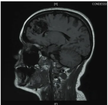 Figura 1B  Axial coronal RM.