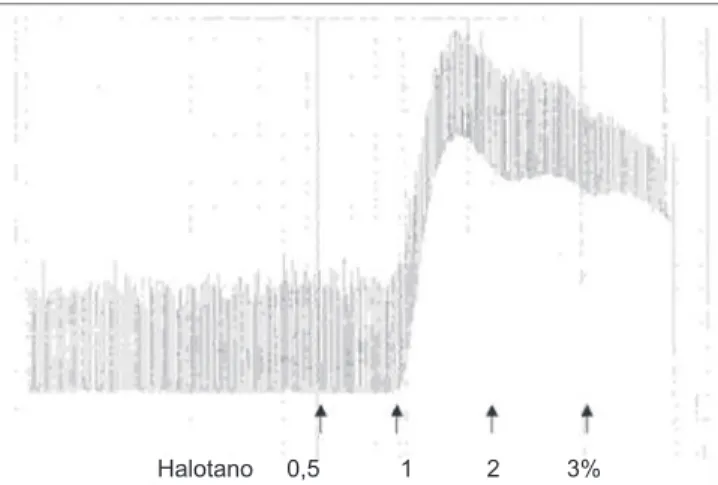 Figura 2 Test de Contractura Muscular in vitro en Respuesta  al Halotano (paciente 4).