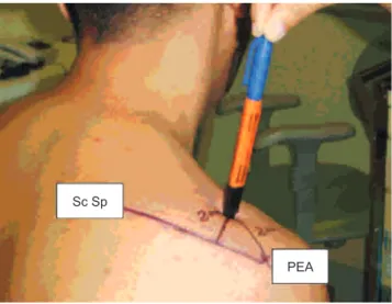 Figure 2  Axillary Nerve Block. 