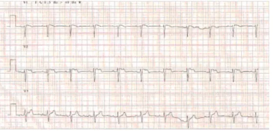 Figure 1  Patient ECG, Showing Type II (saddleback) Pattern in V2.