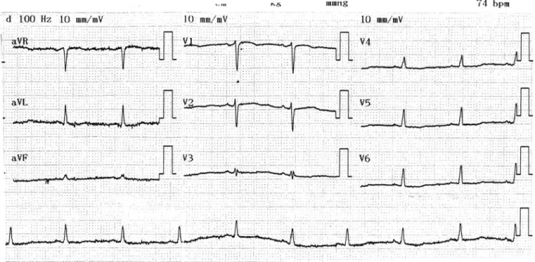 Figure 1 Preanesthetic ECG Image.