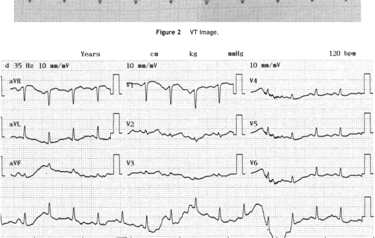 Figure 3 Postextubation ECG image.