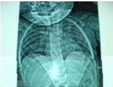 Figura 1 Fragmento de catéter Port-A en un ni˜ no de 2 a˜ nos de edad con linfoma linfoblástico agudo, alojado en el ventrículo derecho y alcanzando la principal vena pulmonar.