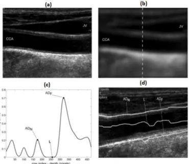 Figura 2.9- Método ACT de Molinari et al.[37]: (a) imagem original; (b) imagem após redução do ruído  speckle com um filtro Gaussiano (linha a tracejado corresponde a uma coluna da imagem); (c) perfis de  intensidade da coluna da imagem; (d) deteção das bo