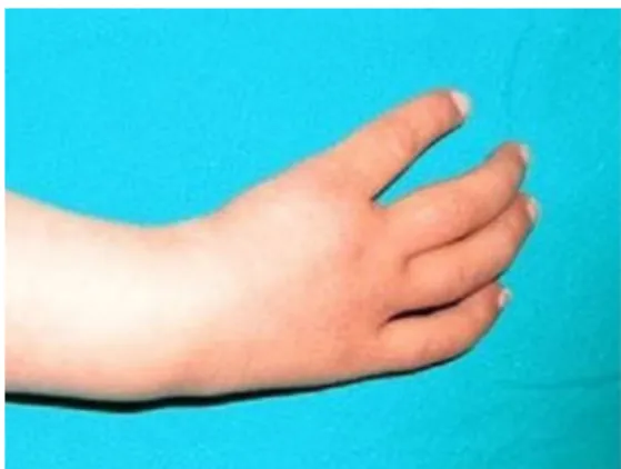 Figure 1 Absence of the thumb.