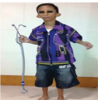 Figura 1 Ni˜ no con síndrome de Seckel.