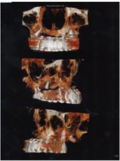 Figura 4 - Tomografia maxila esquerda reconstrução 3D corte axial. Fonte: Gottardo (2016)