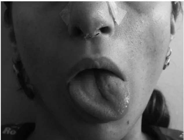 Figure 1 Deviation to the left in the tongue associated with unilateral paralysis of the hypoglossal nerve on the 3rd day postoperatively.