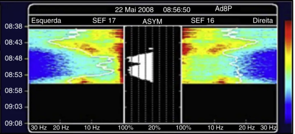 Figura 7 SEF 95% bilateral e espectrograma bilateral com hipersincronizac ¸ão alfa.