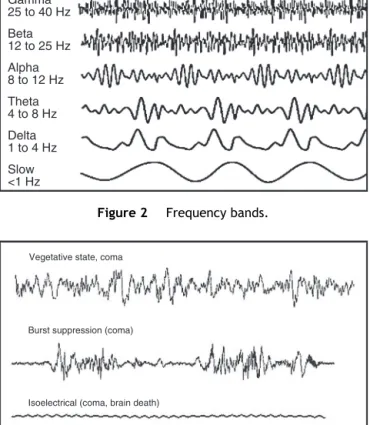 Figure 3 Deep anesthesia standards (isoelectrical or burst suppression). Raw signalEE/EMG Digitalization Filter artifactsDetectionsuppression