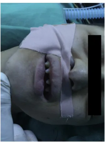 Figure 1 Teeth are reduced and conical in shape (anodontia).