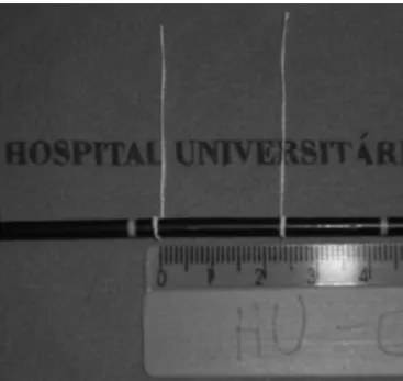 Figure 1 Bronchoscope positioned adjacent to the tracheal carina.
