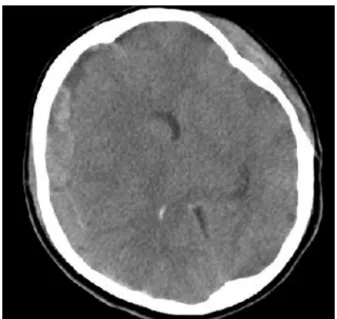 Figure 1 Preoperative brain computed tomography scan demonstrates the right fronto-temporo-parietal acute subdural haematoma with diffuse cerebral oedema.