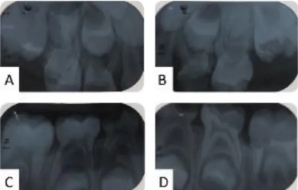 Figura  2  -  Radiografia  periapicais.  Molares  superiores  esquerdos  (A)  e  direitos  (B),  molares inferiores esquerdos (C) e direitos (D) 