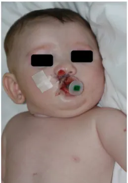 Figura 1 Bebê desperto com a via aérea em sua boca, sem qualquer sinal de irritac ¸ão.