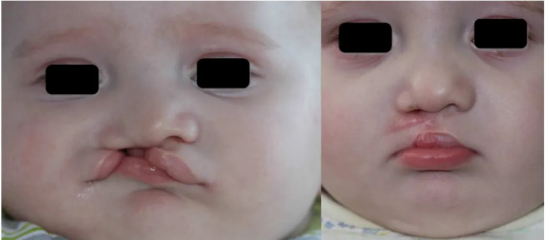 Figure 2 Pre- and postoperative photographs of the patient.