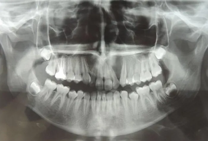 Figura 3 - Acesso cirúrgico intra-oral. Fonte: o autor. 