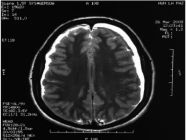 Figure 1 Axial section of brain magnetic resonance where a bilateral subdural hematoma is observed.