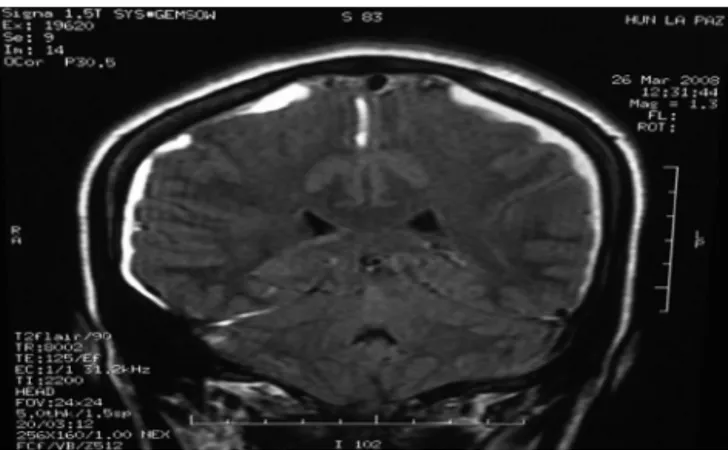 Figure 2 Coronal section of brain magnetic resonance where bilateral subdural hematoma is observed.