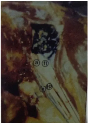 Figure 1 Total involvement of the brachial plexus (yellow).