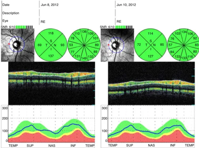 Figure 1 The comparison of the retinal nerve fiber layer thickness measurements obtained by spectral domain, one day before and after the operation.