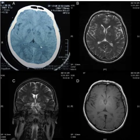 Figure 1 (A) Axial CT, (B) axial T2 MRI, (C) coronal T2 MRI, and (D) axial T1 MRI of Case 1.