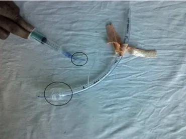 Figure 1 Partially inflated cuff with the collapsed pilot bal- bal-loon.