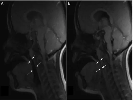Figure 1 Still image (A) from a sagittal cine clip shows the nasopharynx airway (short arrows) and the retroglossal airway (long arrows) as open and the still image (B) shows the retroglossal airway as collapsed.
