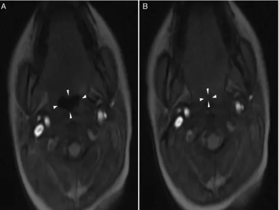Figure 2 Still image (A) from the cine clip shows the retroglossal airway in cross-section while open (arrowheads) and the still image (B) shows the airway completely collapsed centrally compatible with hypopharyngeal collapse.