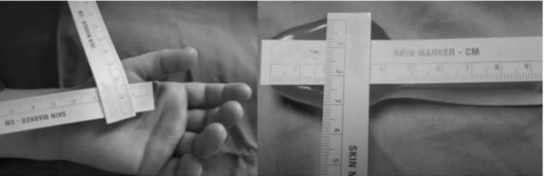 Figure 1 Measuring the vertical and horizontal dimensions of the thenar eminence and the I-gel TM airway device which was inserted into the patient.