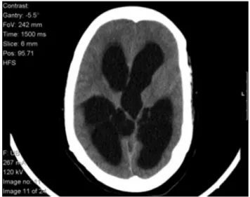 Figure 1 Admission CT scan showing triventricular hydro- hydro-cephalus.