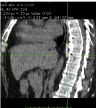 Figure 2 Anterior and posterior epidural venous plexus with contrast.